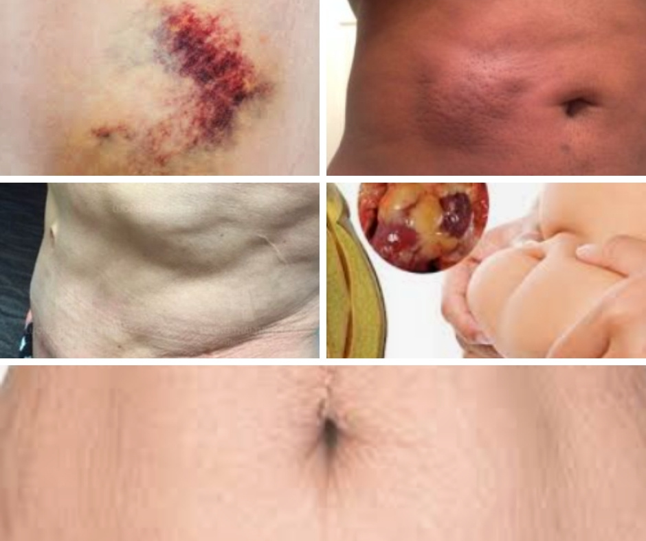 5 Rủi Ro Tiềm Ẩn Của Hút Mỡ Bạn Cần Biết