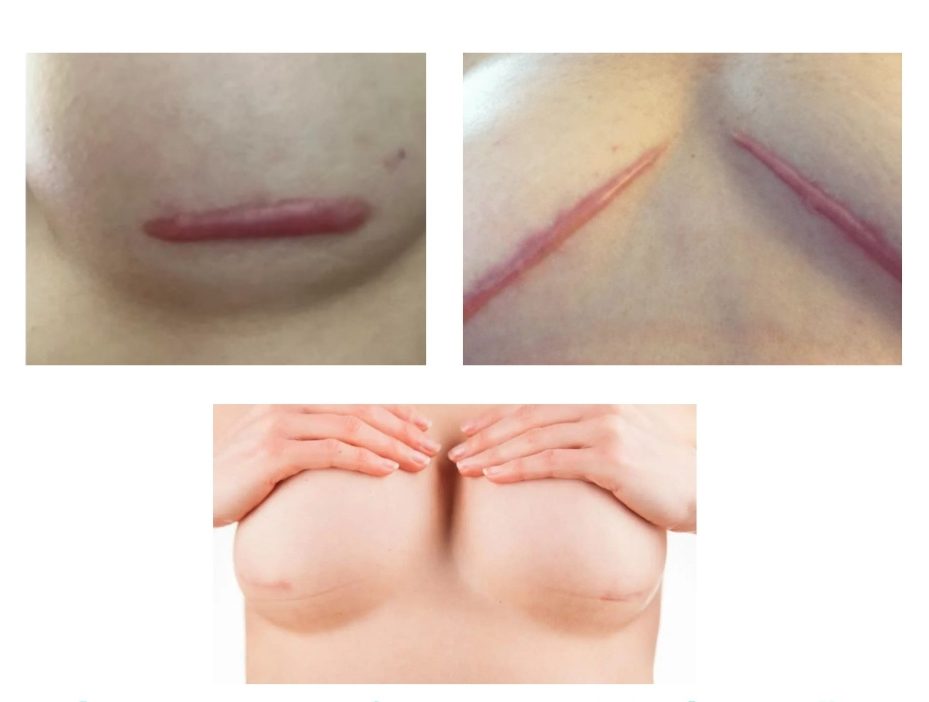 Các loại sẹo nâng ngực thường gặp