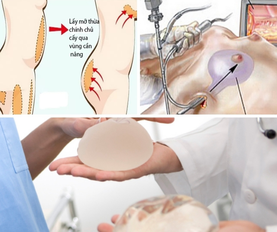 Các phương pháp nâng ngực