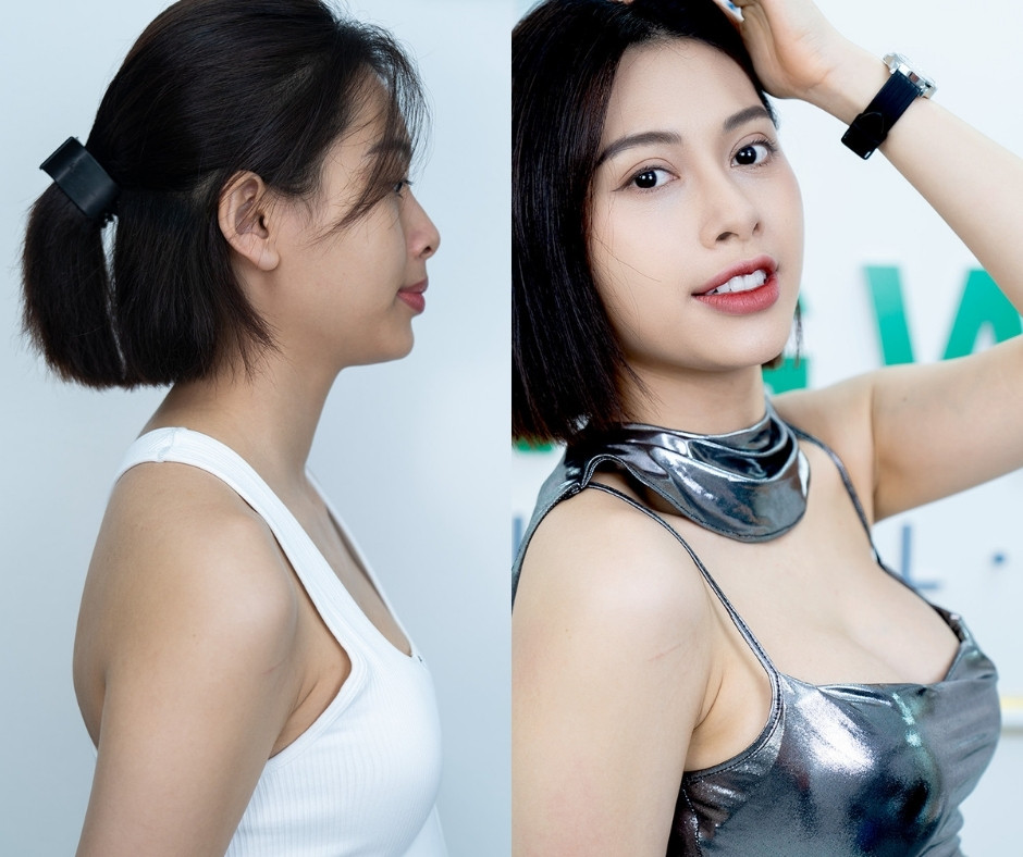 hinh anh truoc va sau nang nguc
