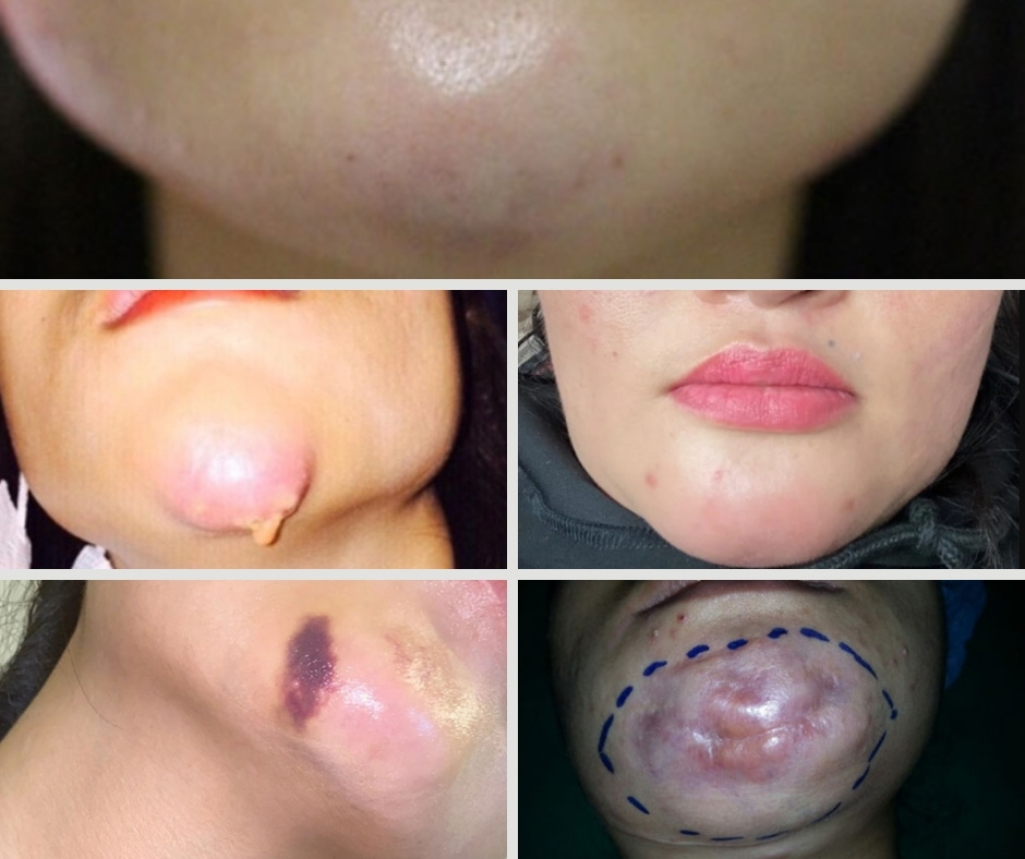 rủi ro khi độn cằm