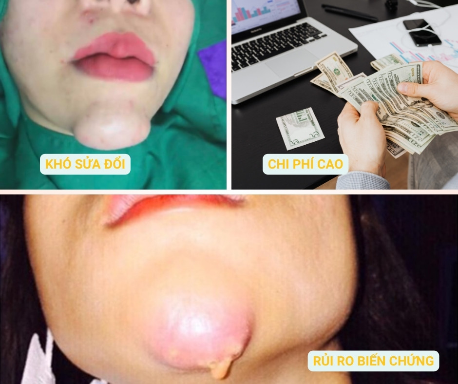 rủi ro khi phẫu thuật độn cằm