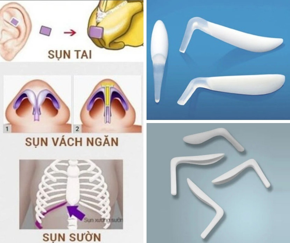 sụn nhân tạo